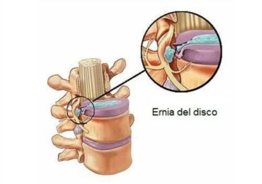 Ernia del disco ed ossigeno-ozonoterapia: perché?